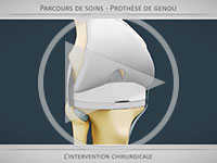 Parcours de soins - Prothèse de genou